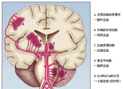 高血压1.jpg