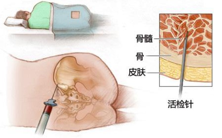 骨穿图片_222.jpg